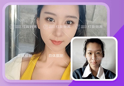 【速美项目】自体脂肪填充