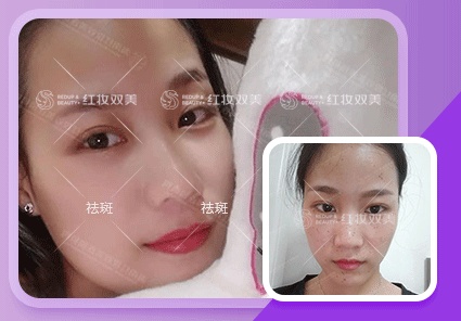 【速美项目】皮秒祛斑