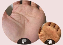 科学分型祛除湿疹