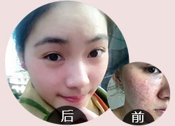 专注痘痘、痤疮祛除