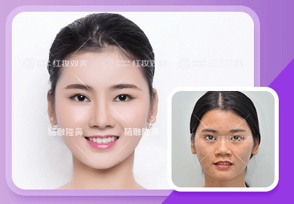 【速美项目】精雕隆鼻