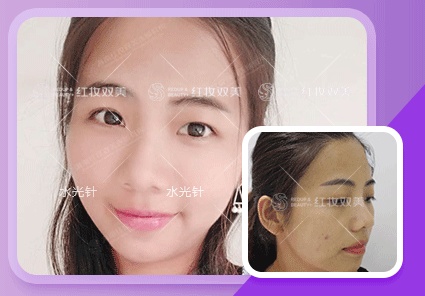 【速美项目】水光针