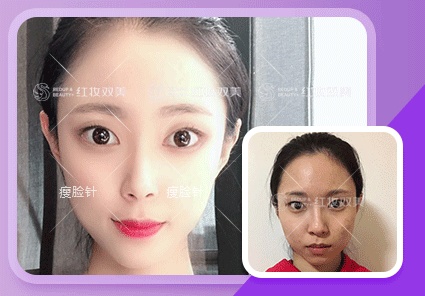 【速美项目】瘦脸针