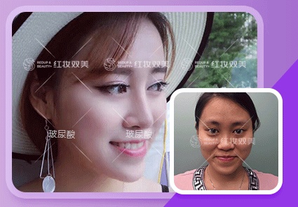 【速美项目】爱芙莱玻尿酸