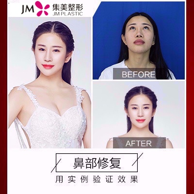 集美鼻部修复
