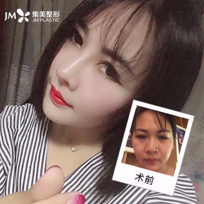 集美隆鼻