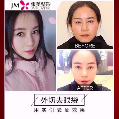 集美祛眼袋前后对比