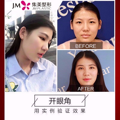 集美开眼解前后对比