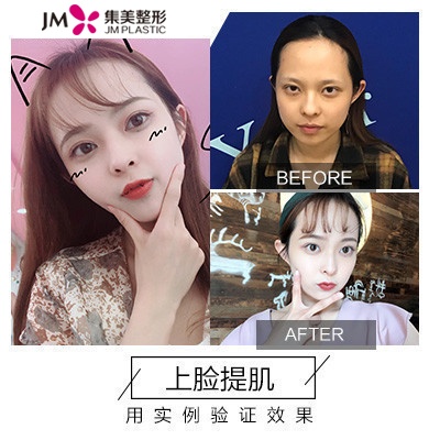 集美双眼皮前后对比