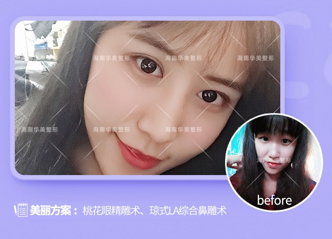 琼式LA综合鼻雕术