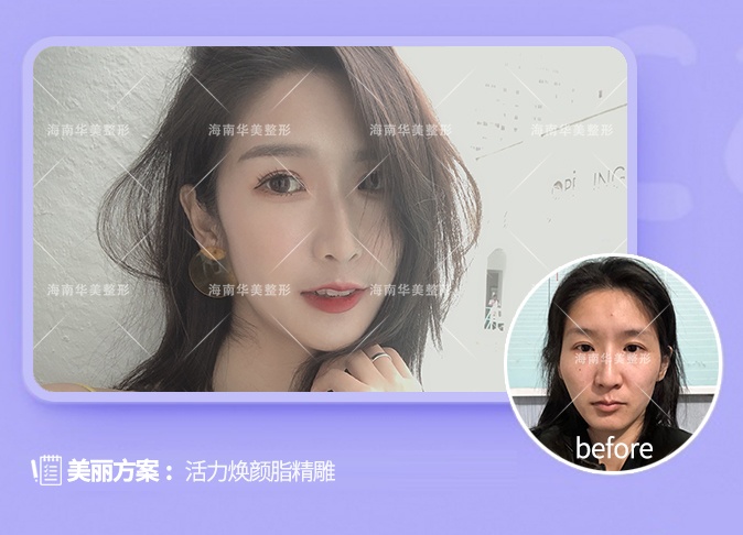 活力焕颜脂雕术