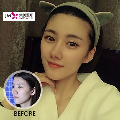 集美隆鼻对比