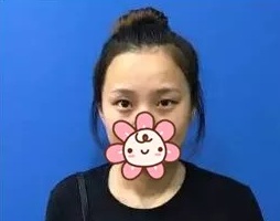 下面就是我的整形手术